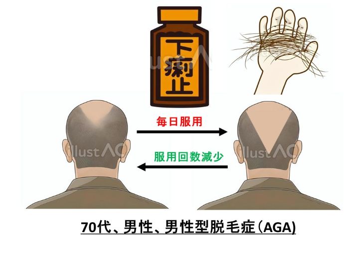 円形脱毛症　病院